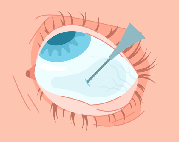 eye_injection