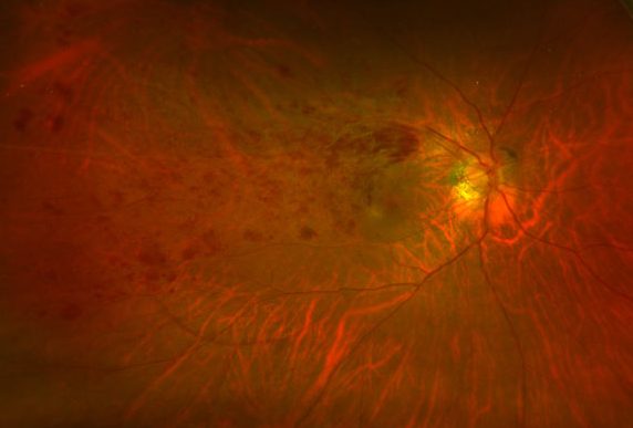 Branch-Retinal-Vein-Occlusion-Fundus