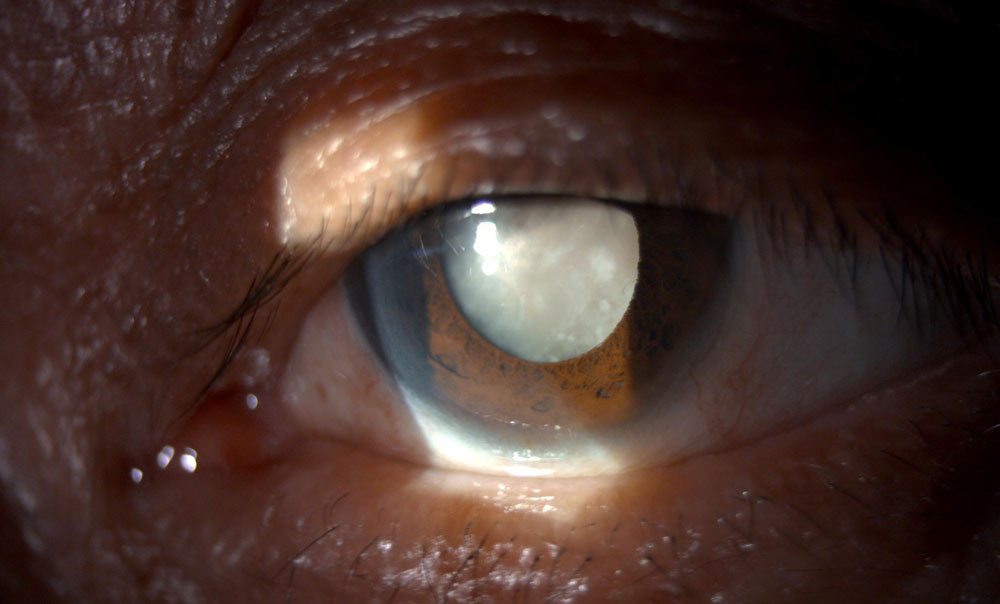 Hypermature---White-Cataract